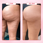 Massageador Anticelulite Pro + 2 Óleos  de brinde