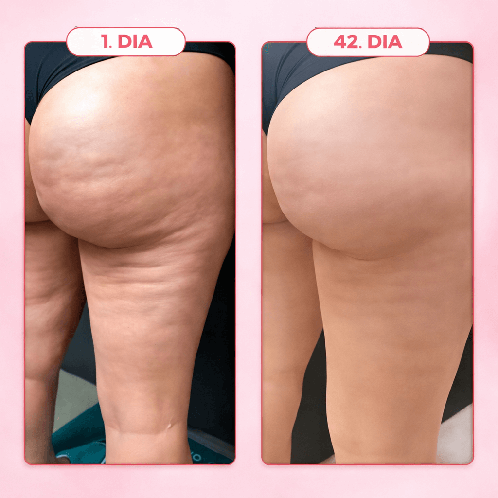 Massageador Anticelulite Pro + 2 Óleos  de brinde